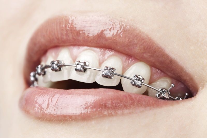 Aparat dentar metalic