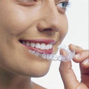 Tipuri de aparate dentare