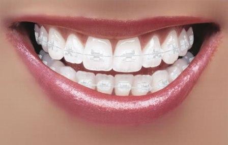 Aparat dentar safir